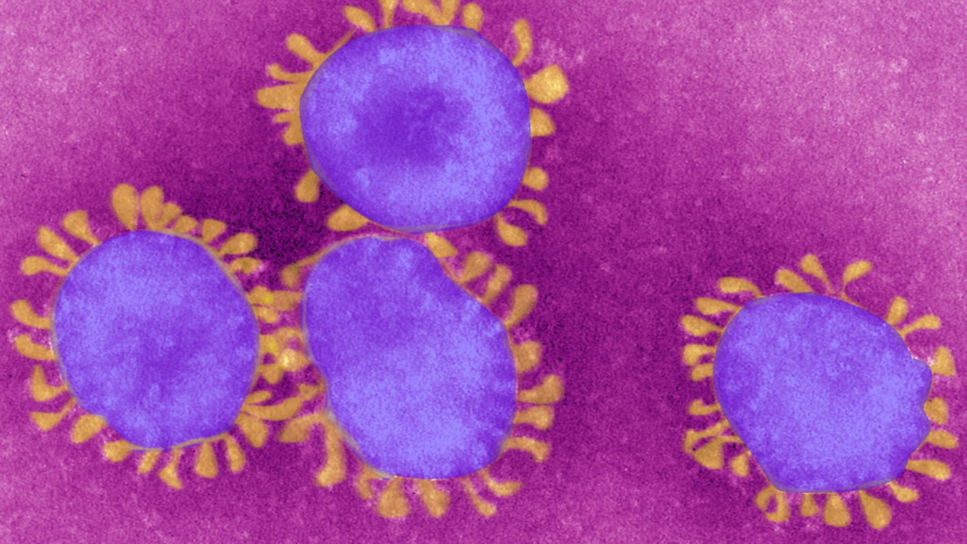 The coronavirus visible under a microscope. (Photo By BSIP/UIG Via Getty Images) - Credit: Universal Images Group via Getty